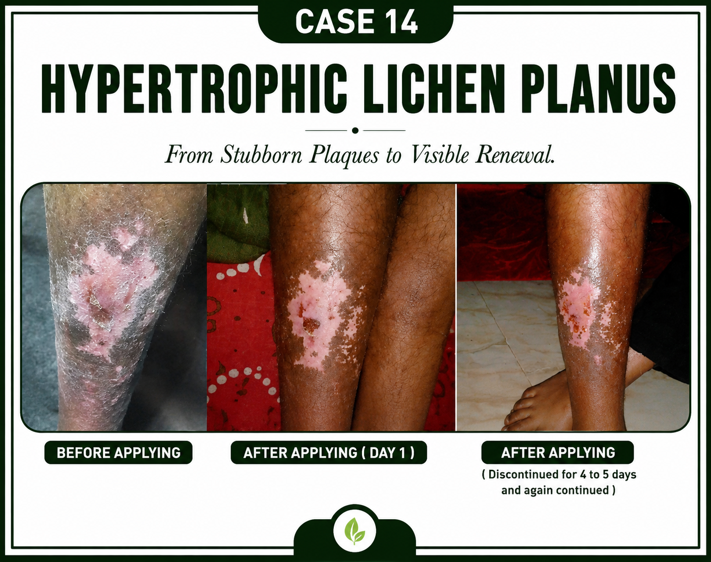 Case 14